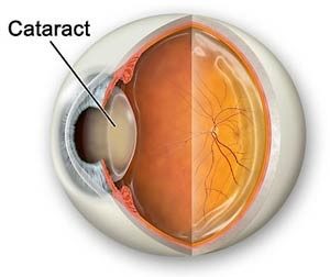 Diagram of a Cataract