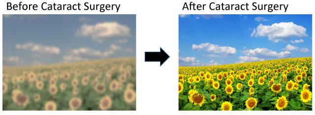 Before and after Cataract Surgery