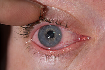 Corneal Abrasion