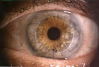 Corneal Transplant Example