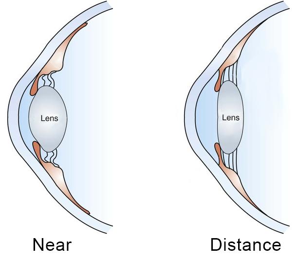 Presbyopia Diagram