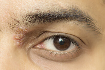 Herpetic Eye Disease