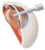 Cataract Surgery Procedure