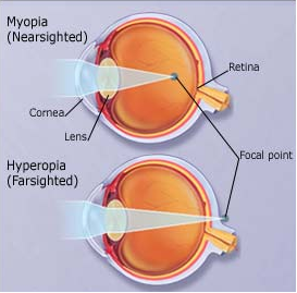 Myopia and Hyperopia Examples