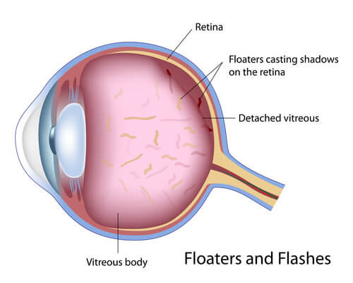 Eye Floaters Example