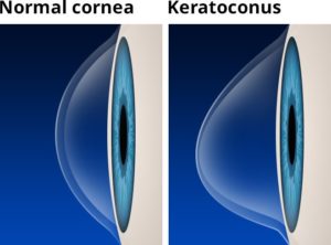 Normal cornea compared to one with Keratoconus