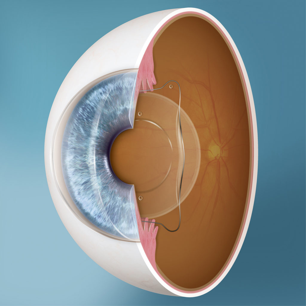 Visian ICL Implant 